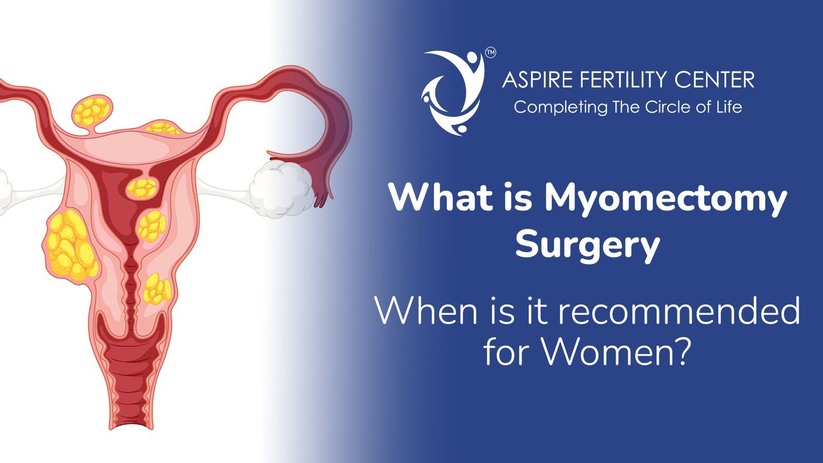 What Is Myomectomy Surgery and When Is It Recommended for Women? Myomectomy Surgery